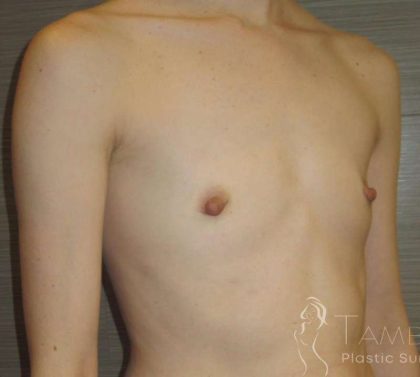 Breast Augmentation Before & After Patient #2081