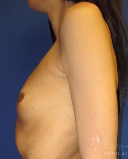Breast Augmentation Before & After Patient #2108