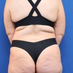 Lower Body Lift Before & After Patient #598