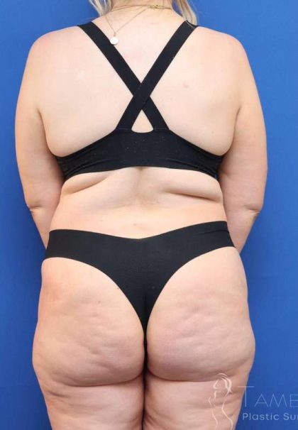 Lower Body Lift Before & After Patient #598