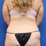 Lower Body Lift Before & After Patient #611
