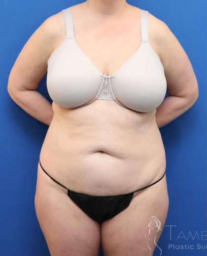 Liposuction Before & After Patient #641
