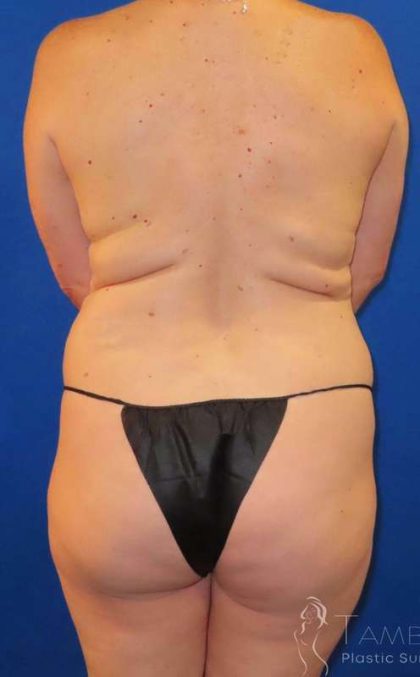 Liposuction Before & After Patient #681