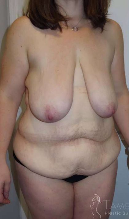Liposuction Before & After Patient #742