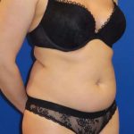 Smartlipo&reg; Before & After Patient #452