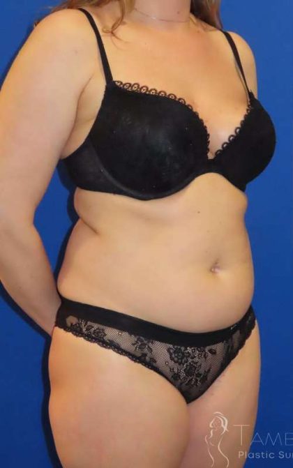 Smartlipo&reg; Before & After Patient #452