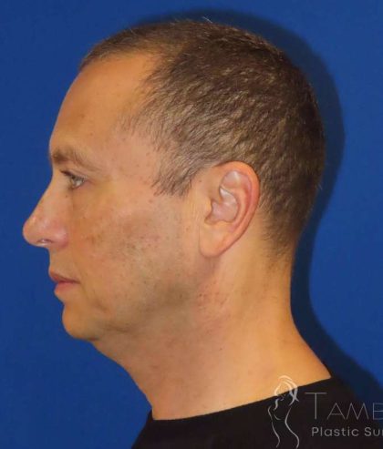Liposuction Before & After Patient #802