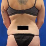 Liposuction Before & After Patient #826