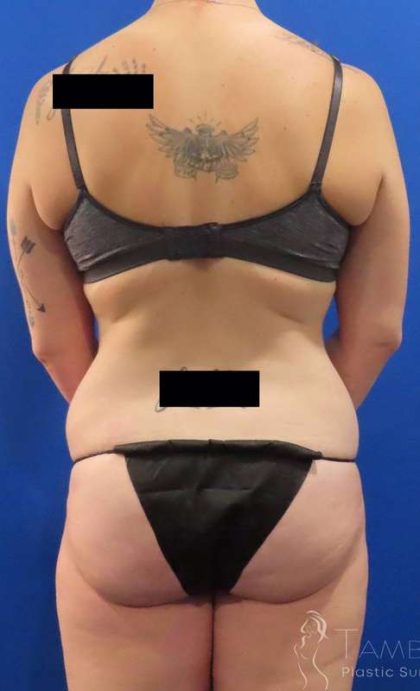 Liposuction Before & After Patient #826