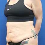 Liposuction Before & After Patient #852
