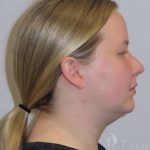 Smartlipo&reg; Before & After Patient #463