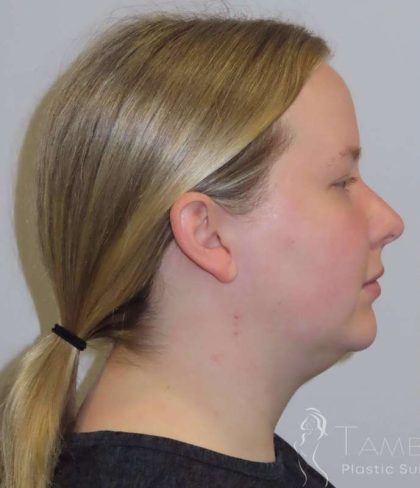 Smartlipo® Before & After Patient #463