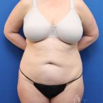 Brazilian Butt Lift Before & After Patient #906