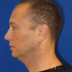 Smartlipo&reg; Before & After Patient #472