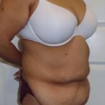 Body Contouring Before & After Patient #1038
