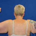Arm Lift Before & After Patient #1096