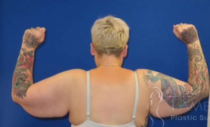 Arm Lift Before & After Patient #1096
