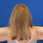 Arm Lift Before & After Patient #1101
