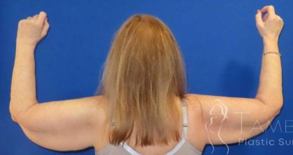 Arm Lift Before & After Patient #1101