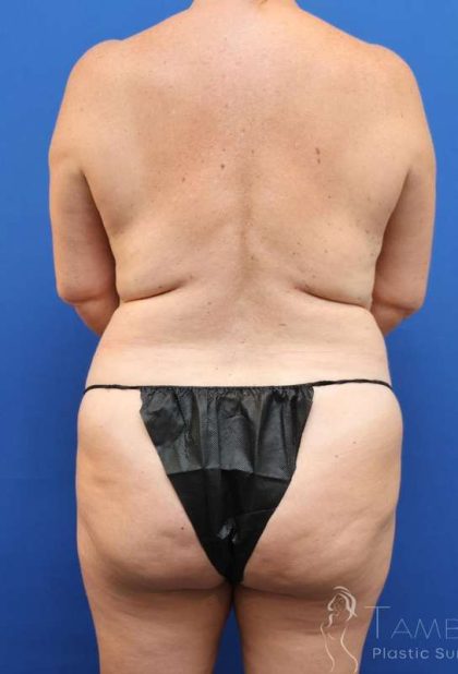 Mommy Makeover Before & After Patient #487