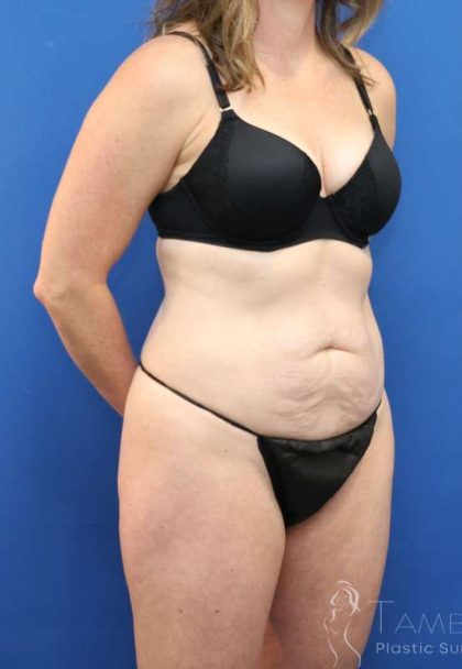 Tummy Tuck Before & After Patient #1153