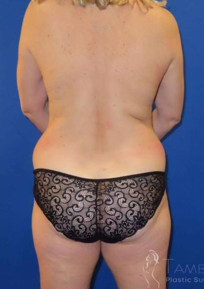 Tummy Tuck Before & After Patient #1177