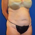 Tummy Tuck Before & After Patient #1190