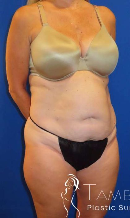 Tummy Tuck Before & After Patient #1190
