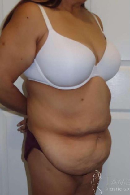 Tummy Tuck Before & After Patient #1214