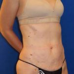 Tummy Tuck Before & After Patient #1236