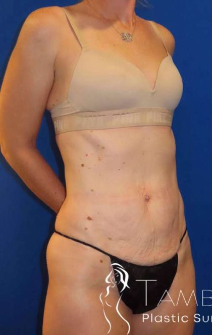 Tummy Tuck Before & After Patient #1236