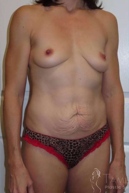 Tummy Tuck Before & After Patient #1284