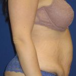Tummy Tuck Before & After Patient #1293
