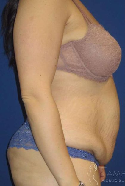 Tummy Tuck Before & After Patient #1293