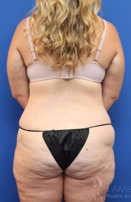 Tummy Tuck Before & After Patient #1343