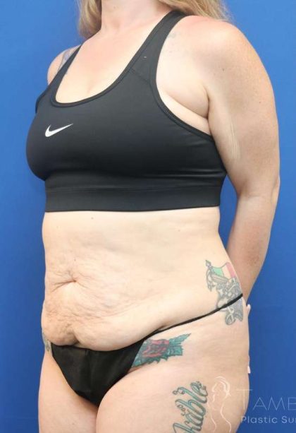 Tummy Tuck Before & After Patient #1369