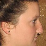 Rhinoplasty Before & After Patient #1406