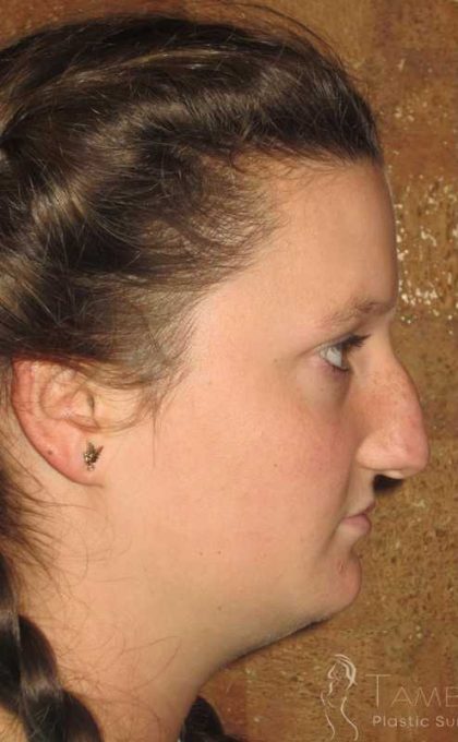 Rhinoplasty Before & After Patient #1406