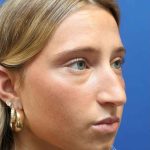 Rhinoplasty Before & After Patient #1415