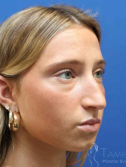 Rhinoplasty Before & After Patient #1415