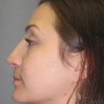 Rhinoplasty Before & After Patient #1424