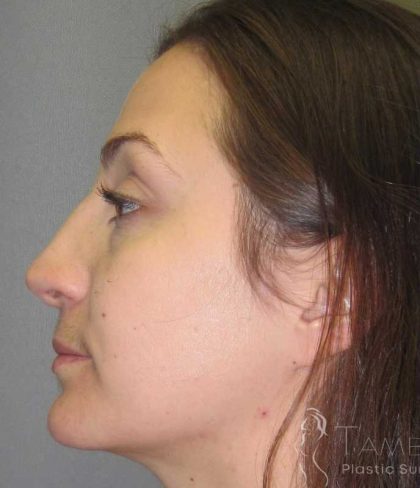 Rhinoplasty Before & After Patient #1424