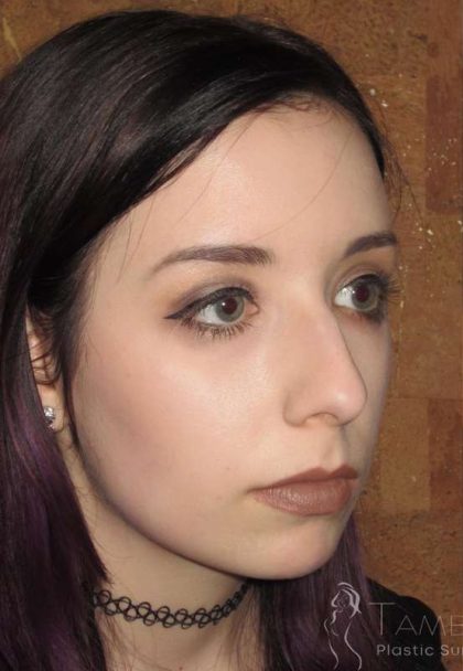Rhinoplasty Before & After Patient #1439