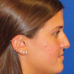 Rhinoplasty Before & After Patient #1454