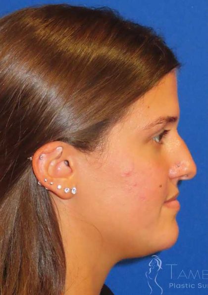 Rhinoplasty Before & After Patient #1454