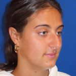 Rhinoplasty Before & After Patient #1465