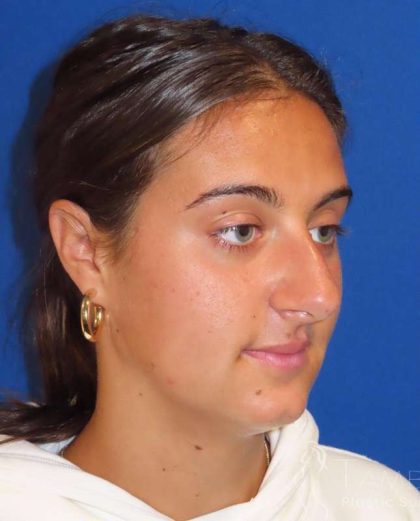 Rhinoplasty Before & After Patient #1465
