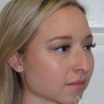 Rhinoplasty Before & After Patient #1476