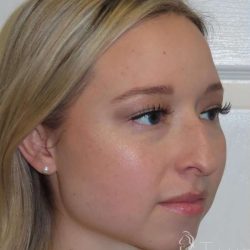 Rhinoplasty Before & After Patient #1476