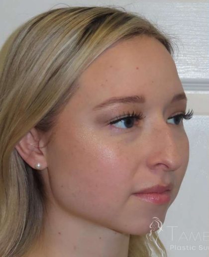 Rhinoplasty Before & After Patient #1476